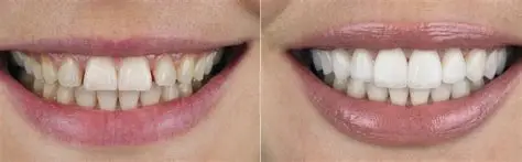 Porcelain Veneers